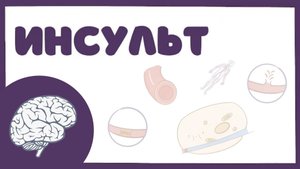 Инсульт - причины, симптомы, лечение (неврология лекция)