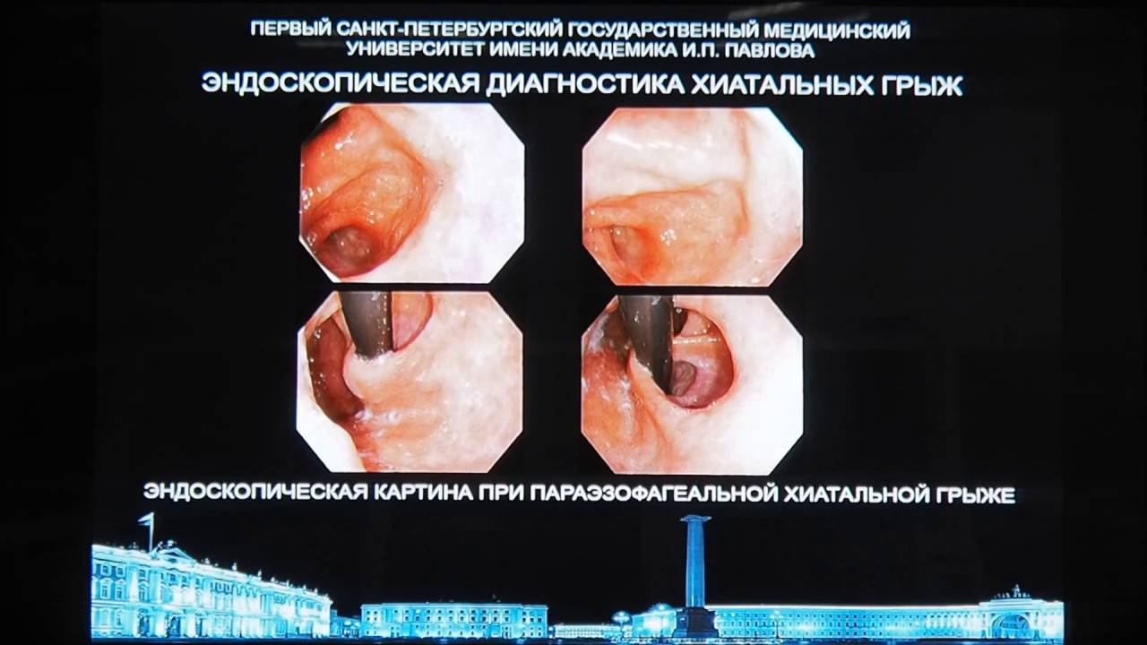 11 Василевский ДИ Аксиальная и параэзофагеальная хиатальные грыжи