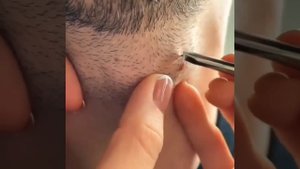 Blackheads extractions-this week | massive old Blackhead on the Neck