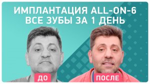 Имплантация all-on-6 – отзывы, как восстановить зубы на верхней челюсти