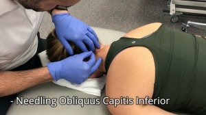 Dry Needling of the Oblique Capitis Inferior Muscle in the Clinic