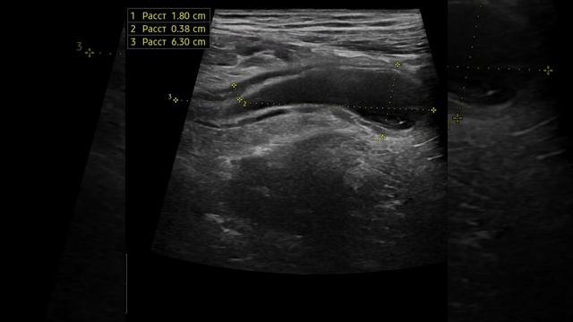 Острый аппендицит на УЗИ смотреть онлайн