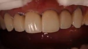 Adhesive cementation of ceramic veneers