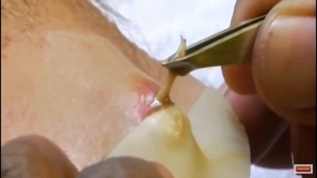 Насекомые из человеческого тела смотреть онлайн