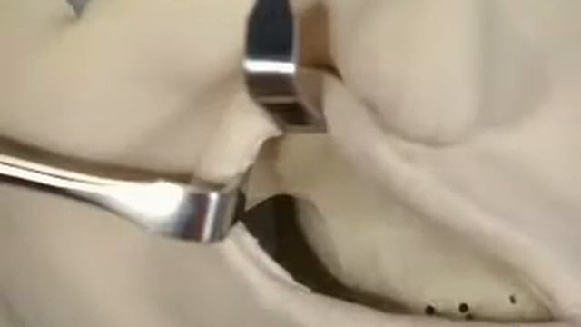 Фиксация отломков при переломе скуловой дуги смотреть онлайн