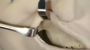 Фиксация отломков при переломе скуловой дуги