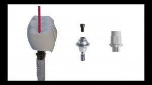 Выбор абатмента при протезировании на имплантатах с использованием винтовой фиксации