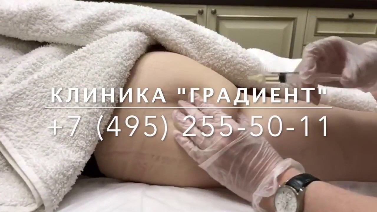 ЛИПОЛИТИКИ - уколы для похудения