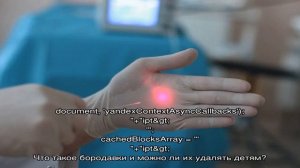 Удаление бородавок у детей с помощью лазера и криодеструкции (жидким азотом)