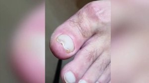 Панариций на большом пальце???