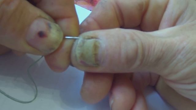 Удаление ногтя. 16+ смотреть онлайн