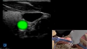 Катетеризация внутренней яремной вены под контролем ультразвука с продольным доступом