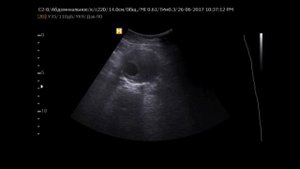 Крупная аневризма инфраренального отдела аорты