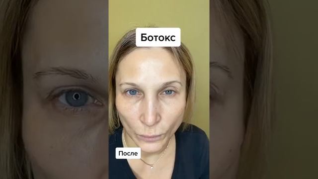 Ботокс. Результат до/после.