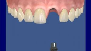 Одномоментная имплантация  в области переднего зуба