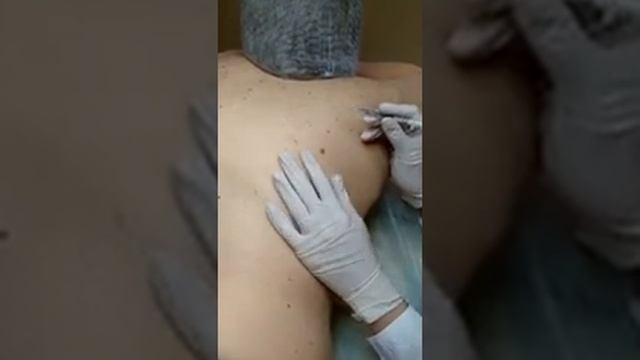 Удаление себорейной кератомы лазером. Процедуру провела Карпова Е.Н.
