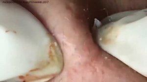 How to Get Rid of Blackheads & Whiteheads on The Face Easy ~ Acne Treatmen #12