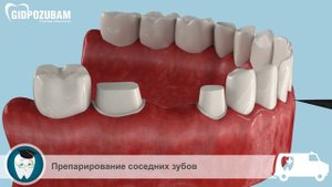 Мостовидный зубной протез. Процесс установки зубного моста
