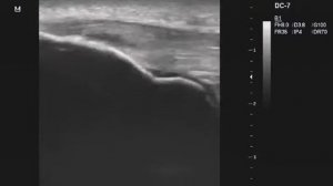 Хронический тендинит собственной связки надколенника