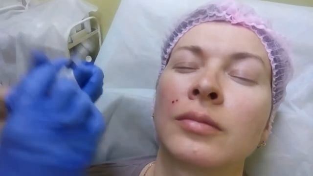 #15 Контурная пластика лица смотреть онлайн