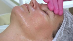 Химический поверхностный пилинг лица