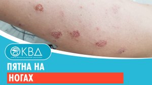 Пятна на ногах. Клинический случай №108