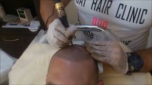 Скалп Микро Пигментация / Scalp Micro Pigmentation
