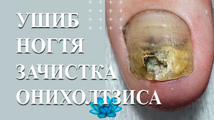 Аппаратный педикюр, когда у клиента ушиб пальца на ноге.