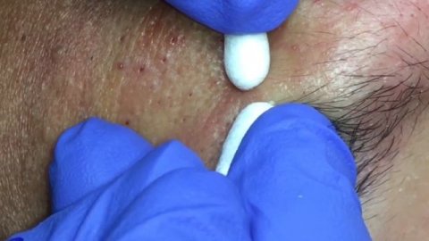 Blackheads on forehead