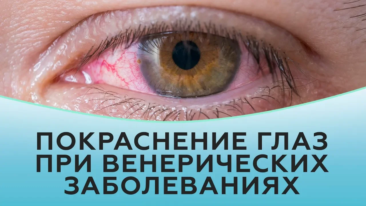 Покраснение глаз при венерических заболеваниях