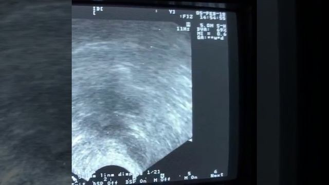 Пункция кисты яичника смотреть онлайн