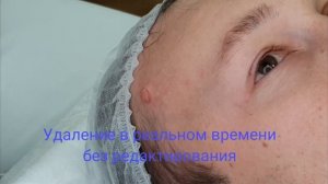 Удаление РОДИНКИ.