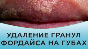 Удаление гранул Фордайса на губах