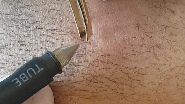 Электро эпиляция (видео 1)