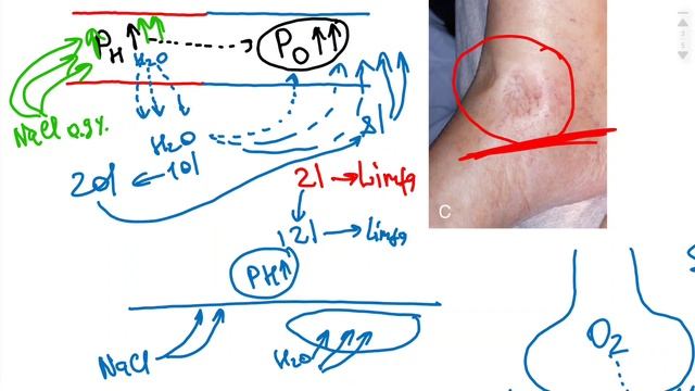 GIPERTONIK | GIPOTONIK | IZOTONIK KASALLIKLAR смотреть онлайн