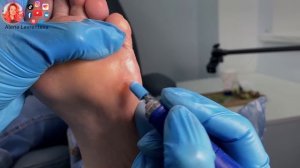 Удаление стержневой мозоли на стопе