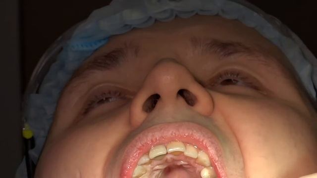 Как вставляют импланты в стоматологии "Евростом экстра" смотреть онлайн