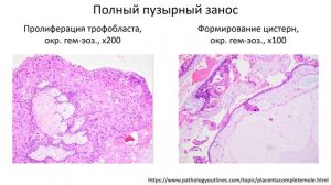 02-38 Гестационная трофобластическая болезнь