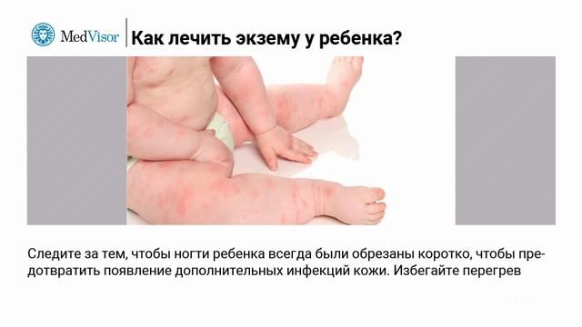 Как лечить экзему у ребенка? смотреть онлайн