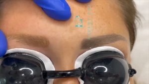 Лазерное удаление серых бровей