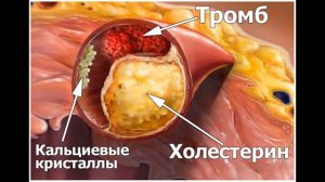 Как продлить жизнь легко Инфаркт, инсульт  Статины, антиагреганты  #чудо #спасение