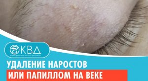 ? Удаление наростов или папиллом на веке. Клинический случай №588