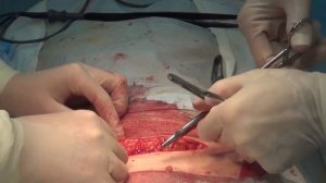 Косметический шов  Лапаротомия по Пфанненштилю Cosmetic suture Laparotomy by Pfannenstiel 美容缝合