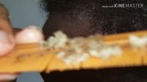 Huge hand full of flakes !!!!!!!! Part 2 SCRATCHING MY SCALP