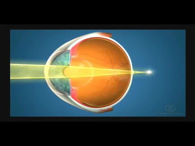 Дальнозоркость