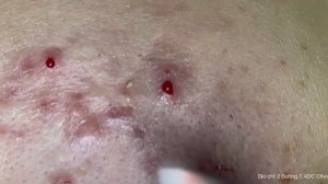 Big Cystic Acne Blackheads Extraction Blackheads & Milia, Whiteheads Removal Pimple Popping