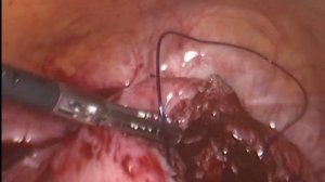 Лапароскопия. Удаление миомы матки.