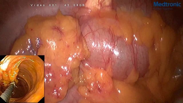 Hybrid laparoendoscopic resection of cecum. НМИЦ Блохина 02.02.2018