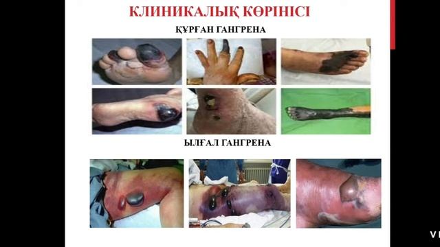 Анаэробтар инфекциялардың қоздырушылары смотреть онлайн