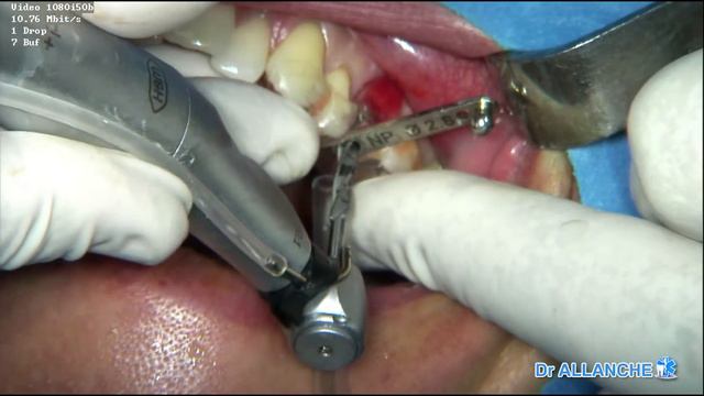 Chirurgie suite à la planification implantaire avec la fraiseuse bravo 5d